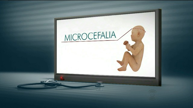 microcefalia.jpg